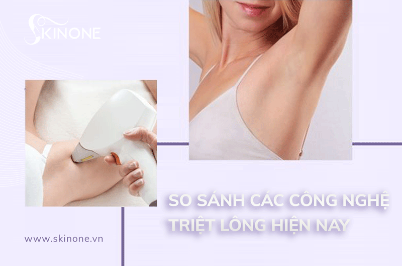 So sánh các công nghệ triệt lông hiện nay hiệu quả nhất