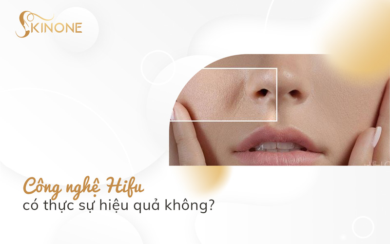 Công nghệ Hifu có thực sự hiệu quả không?