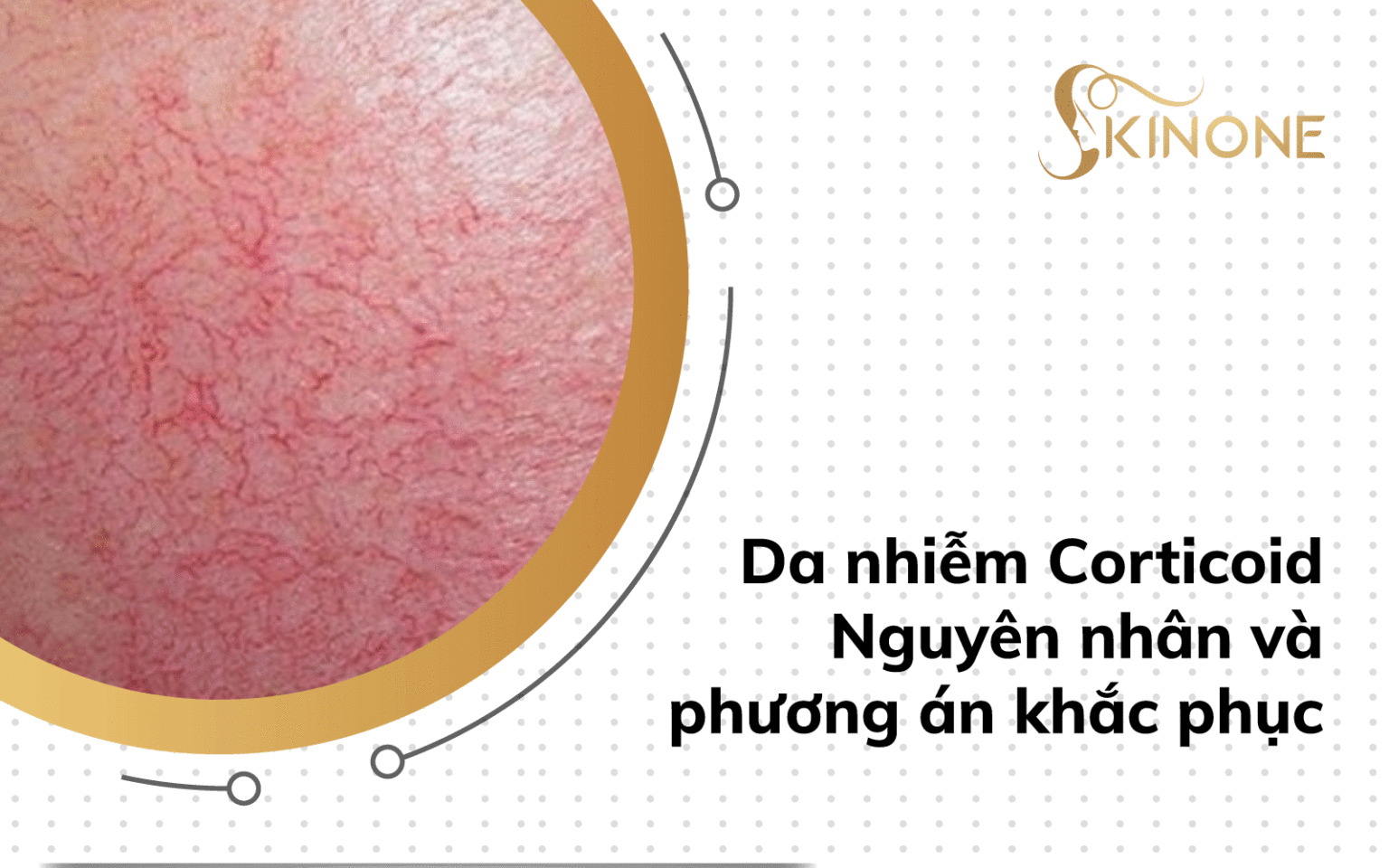 Da nhiễm Corticoid – Nguyên nhân và phương án khắc phục!