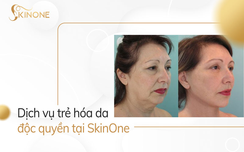 Dịch vụ trẻ hóa da độc quyền tại SkinOne