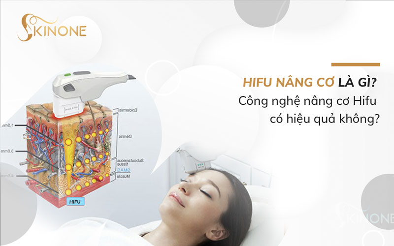 Hifu nâng cơ là gì? Công nghệ nâng cơ Hifu có hiệu quả không?