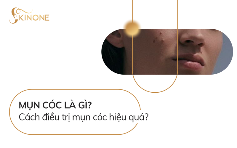 Mụn cóc là gì? Cách điều trị mụn cóc hiệu quả?