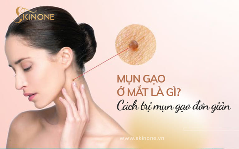 Mụn gạo ở mắt là gì? Cách trị mụn gạo đơn giản