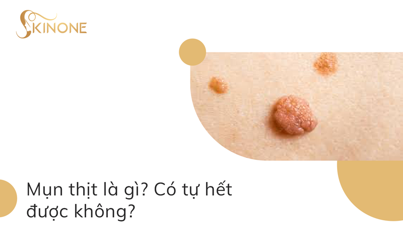 Mụn thịt là gì? Có tự hết được không?