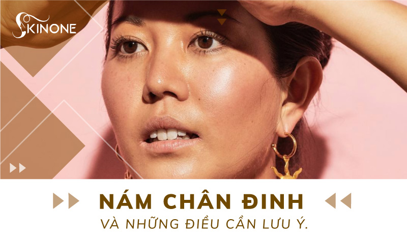 Nám chân đinh và những điều cần lưu ý