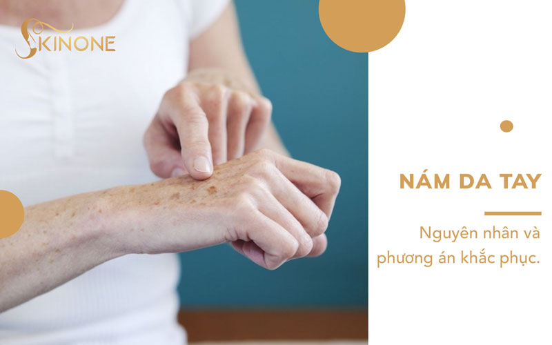 Nám da tay – Nguyên nhân và phương án khắc phục