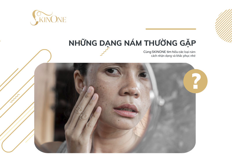 Nám da và những dạng nám da thường gặp