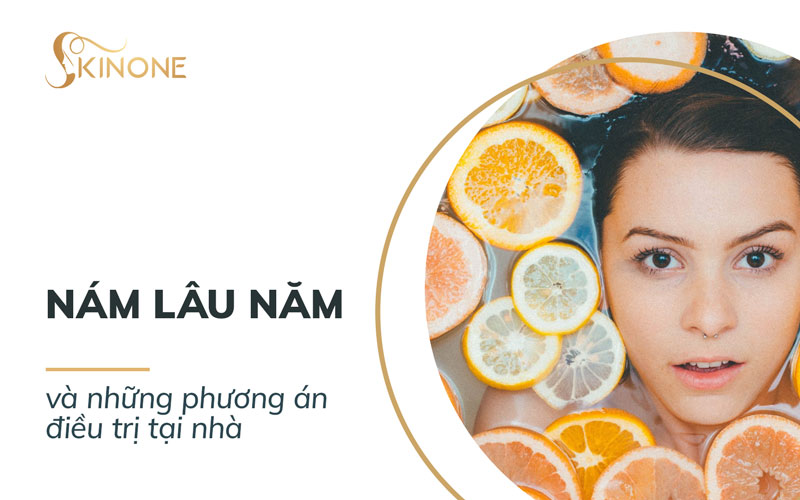 Nám lâu năm và những phương án điều trị tại nhà