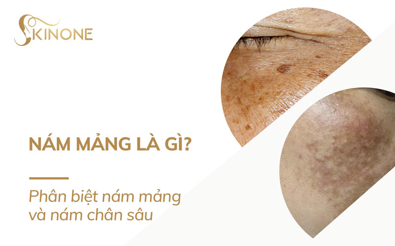 Nám mảng là gì? Nguyên nhân gây ra nám mảng