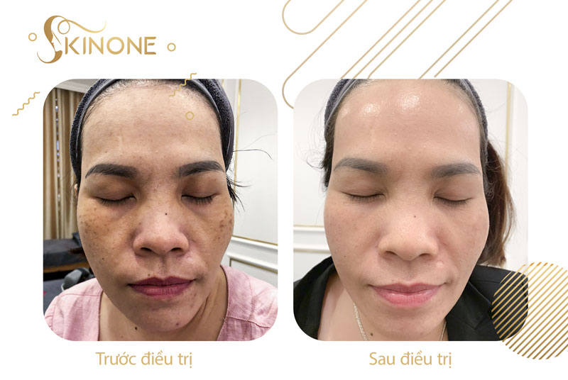 Điều trị nám sau sinh tại SkinOne