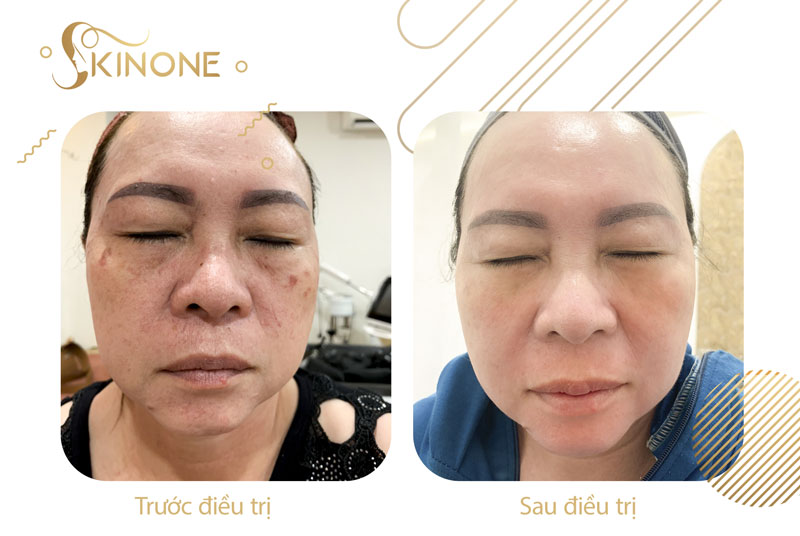 Điều trị nám sau sinh tại SkinOne