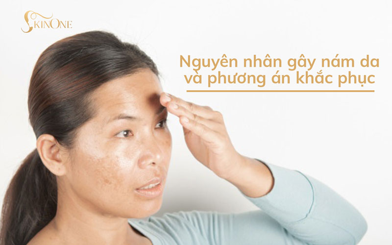 Nguyên nhân gây nám da và phương án khắc phục