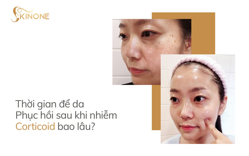 Thời gian để da phục hồi sau khi nhiễm Corticoid bao lâu?