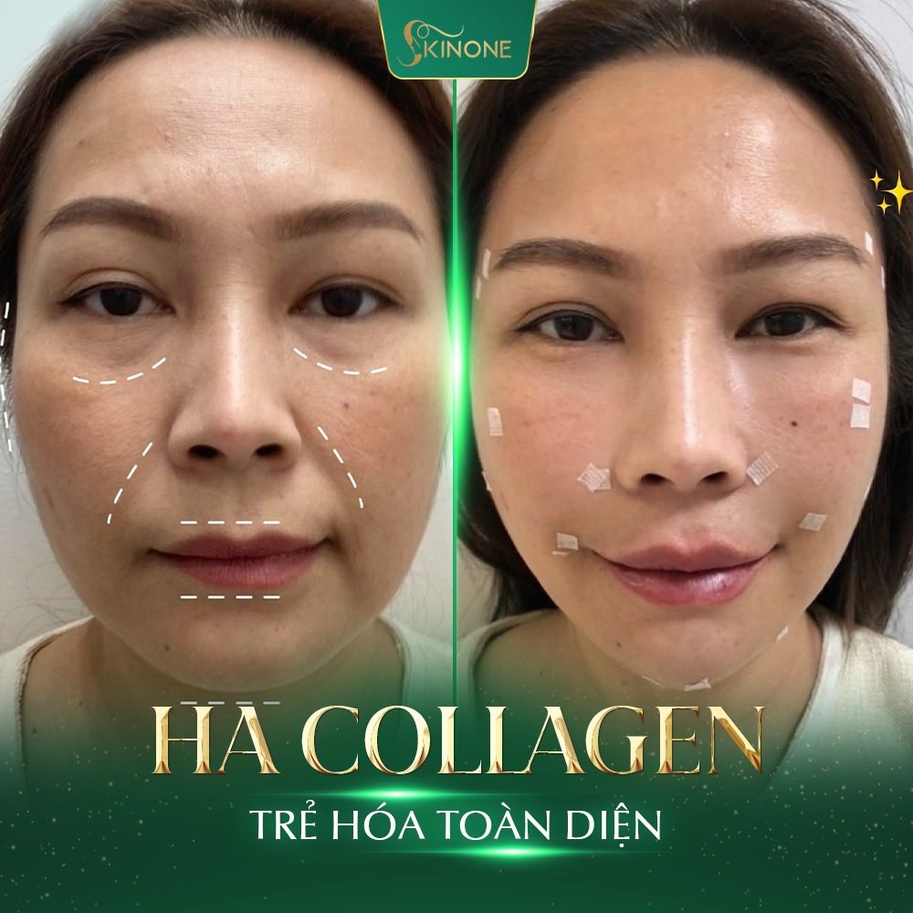 Cấy HA Collagen tại SkinOne mang đến vẻ đẹp tự nhiên