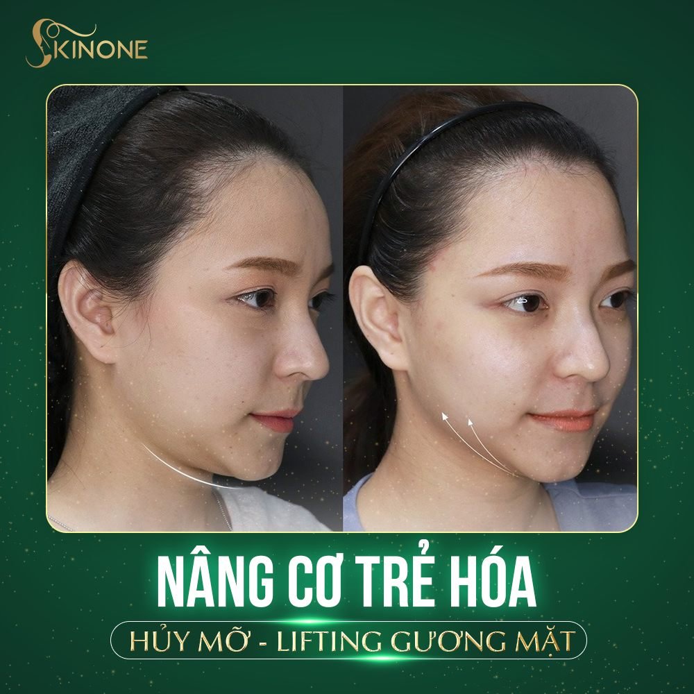 Đánh tan mỡ má sau Hifu Linear Z tại SkinOne