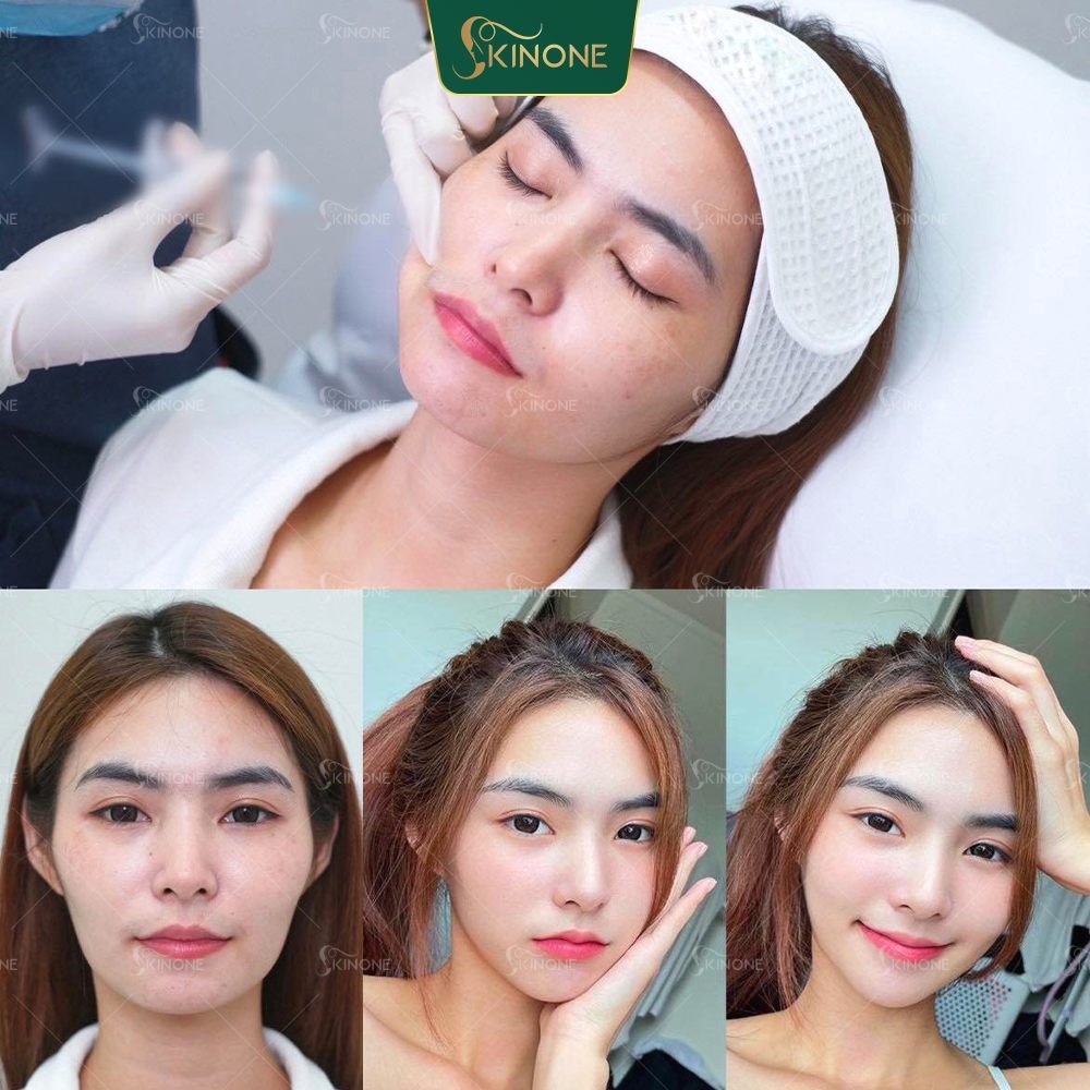 Cấy HA Collagen vùng má chỉ an toàn khi thực hiện đúng cơ sở, đúng hoạt chất, đúng chỉ định và chính tay bác sĩ làm đẹp