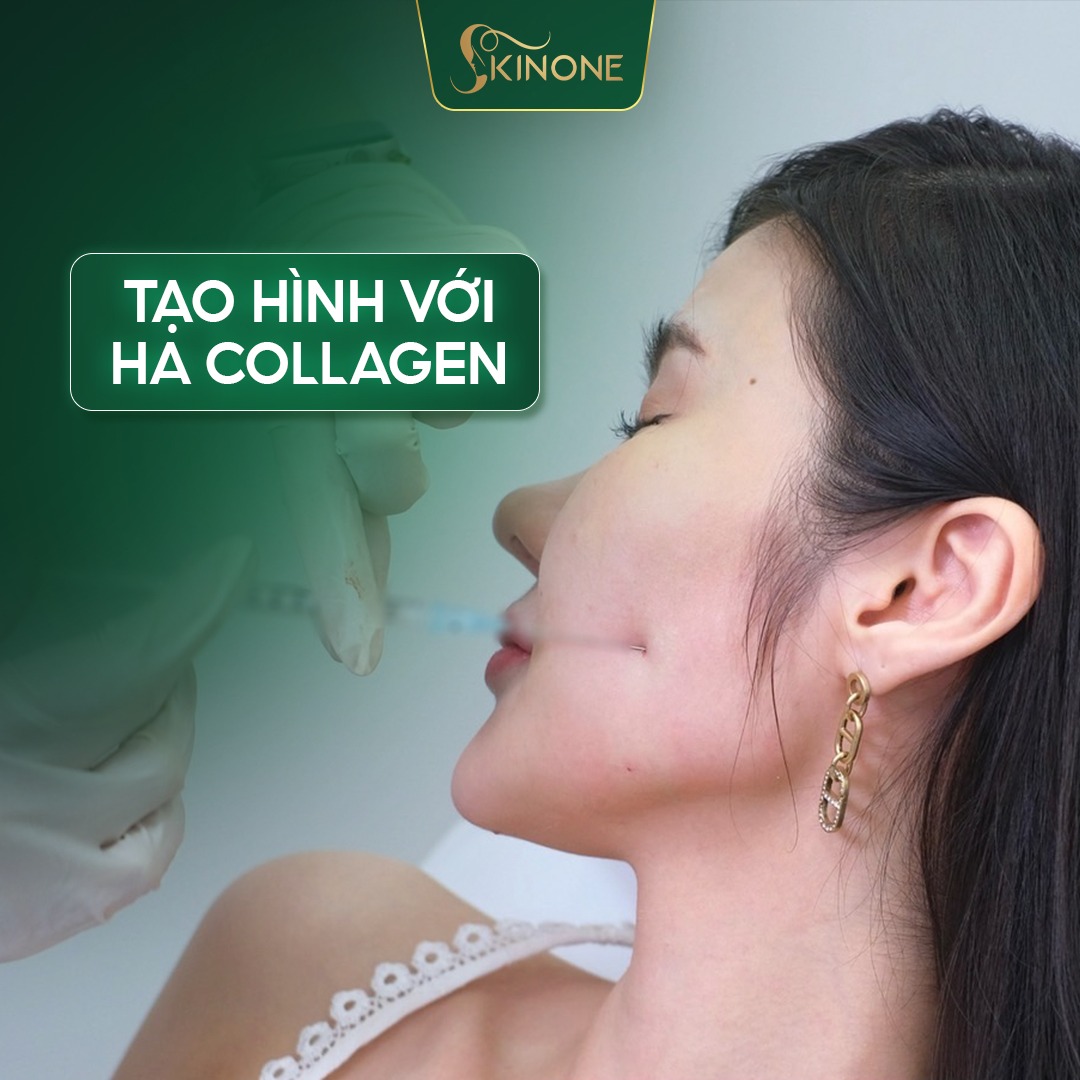 Bác sĩ sẽ tiến hành cấy HA Collagen SkinOne