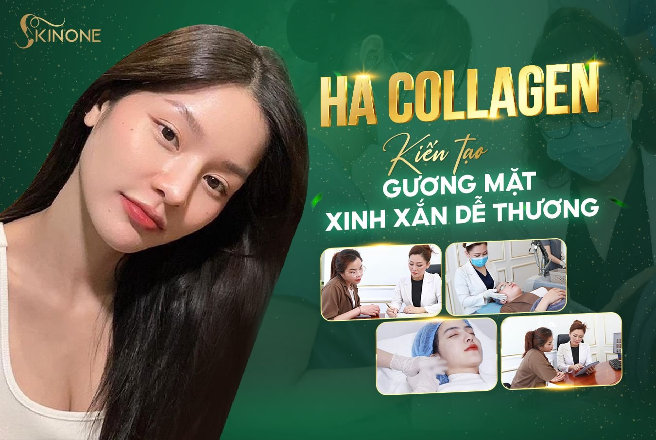 Quy trình cấy HA Collagen vùng má SkinOne