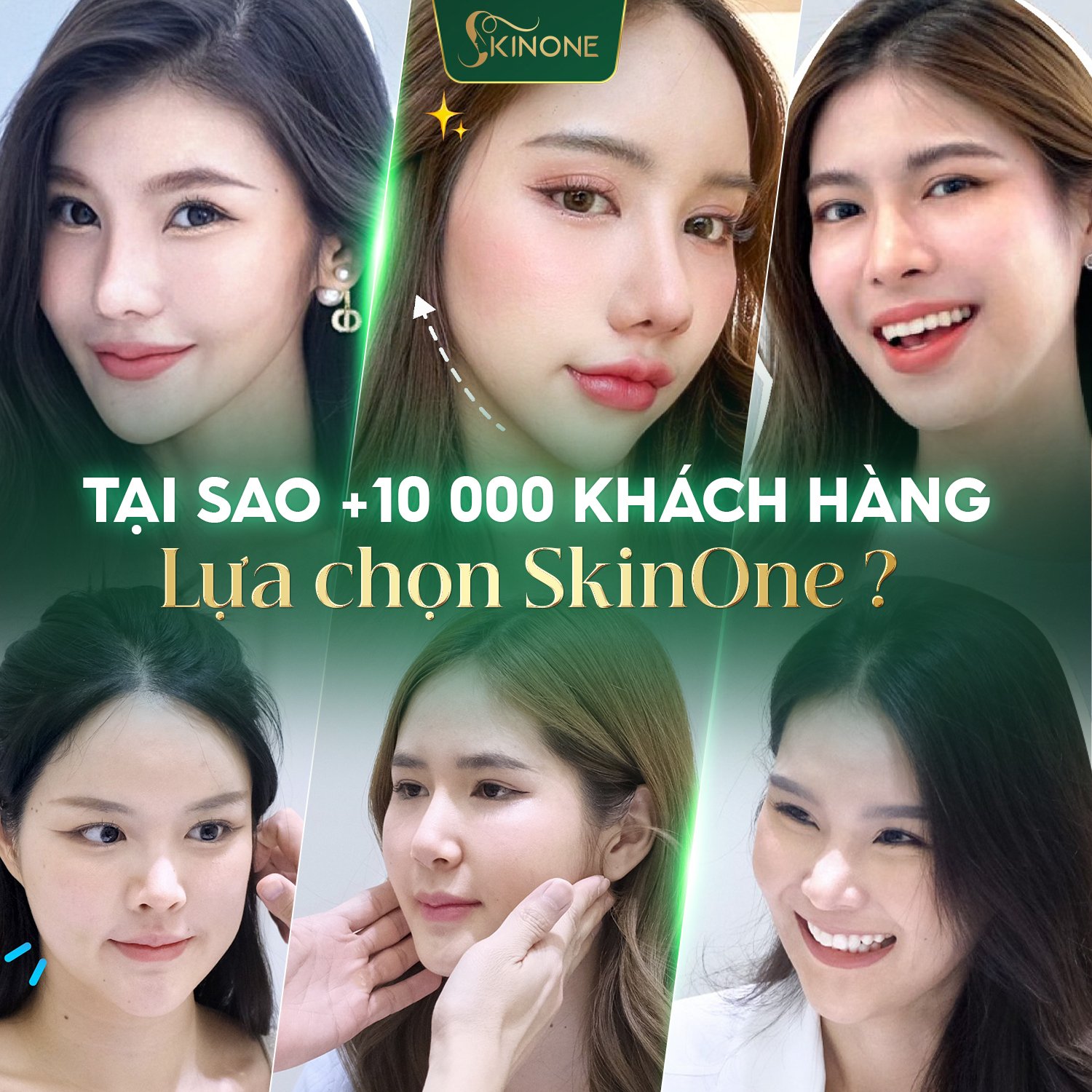 Cấy HA Collagen vùng má SkinOne được nhiều khách hàng yêu thích