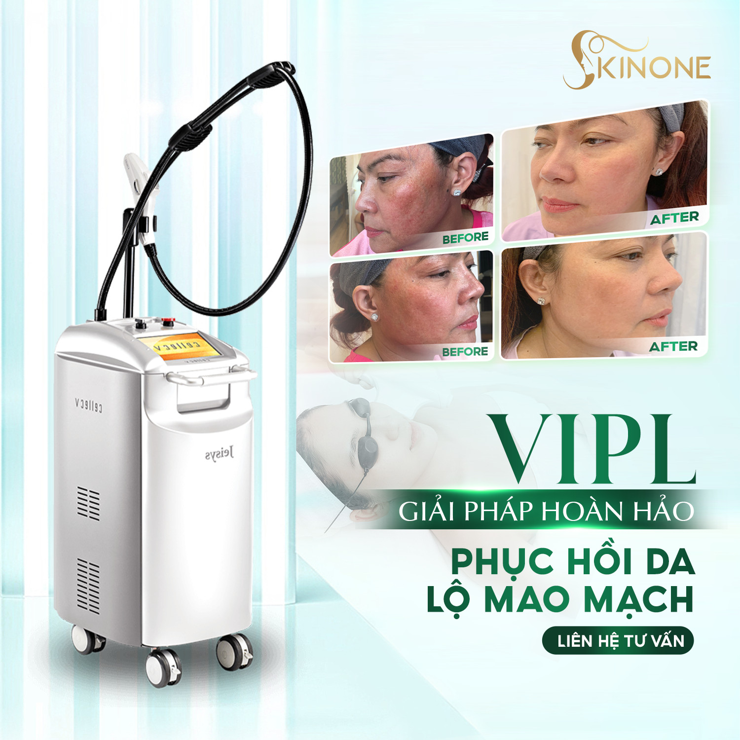 TẠI SAO VIPL SKINONE LẠI HỖ TRỢ QUÁ TRÌNH TRỊ NÁM ?