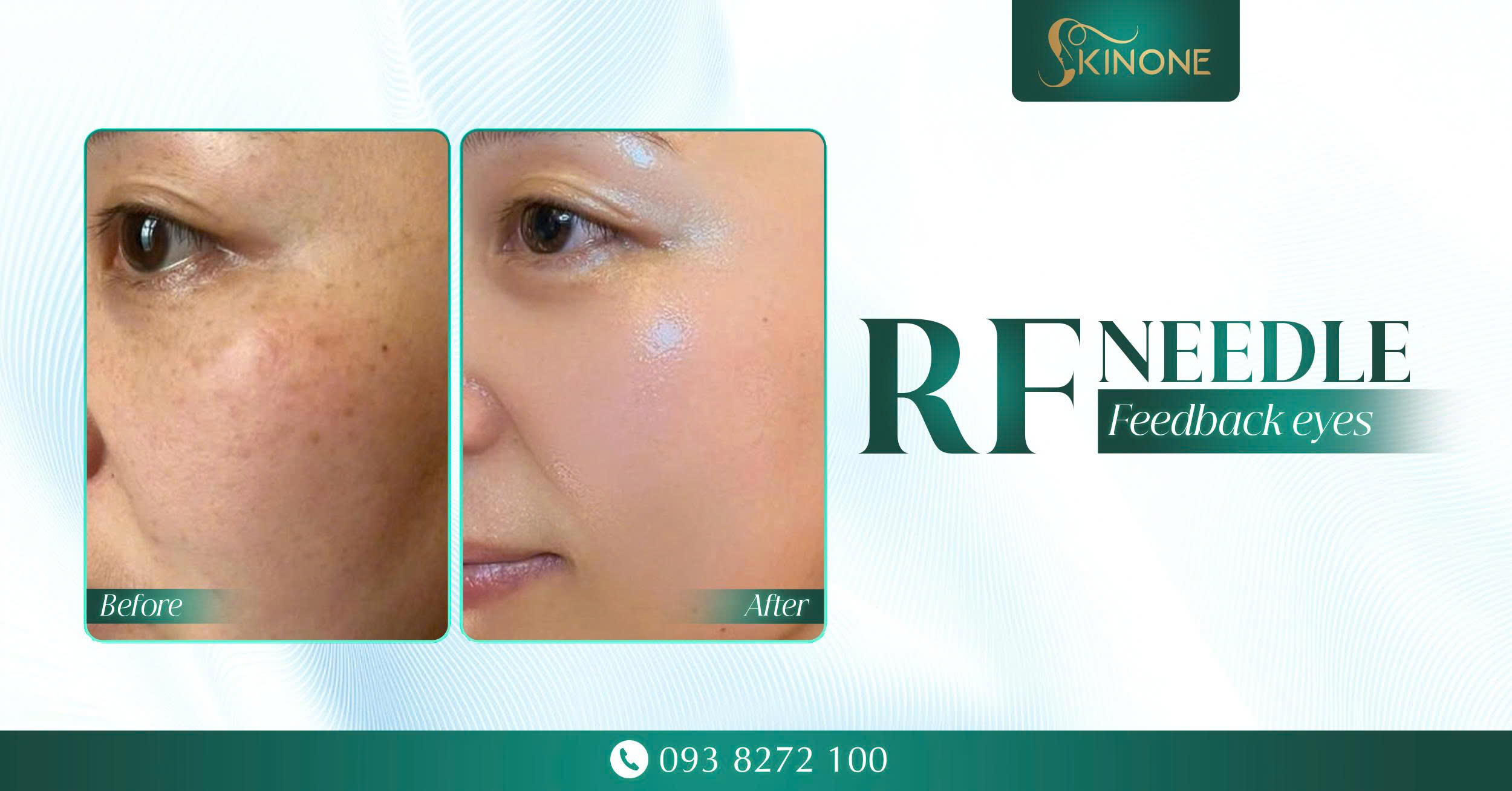 FEEDBACK CÔNG NGHỆ RF NEEDLE